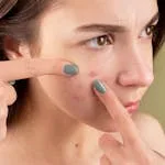 Close-up of a young woman treating her acne-prone skin.