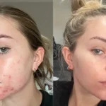 Azelaic Acid: The Under-the-Radar Skincare Ingredient Everyone Should Be Using
